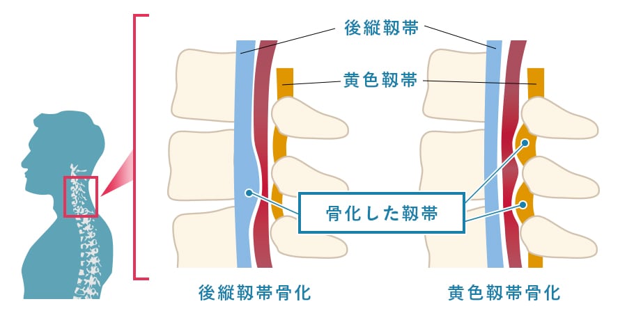 後縦靱帯骨化症・黄色靱帯骨化症