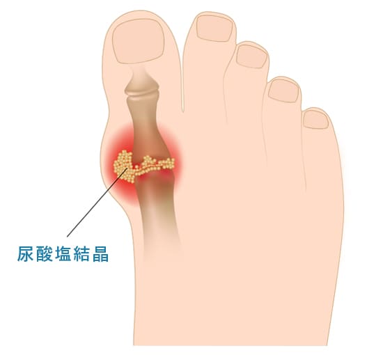 痛風による足親指の尿酸塩結晶
