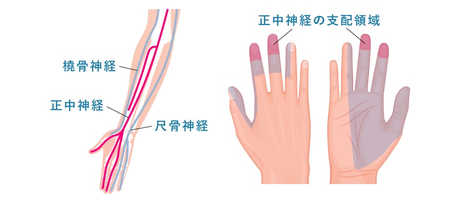 正中神経麻痺