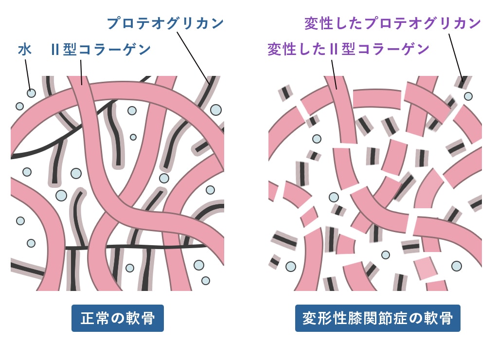 変形性関節症