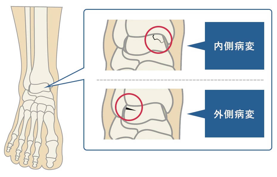 距骨骨軟骨損傷