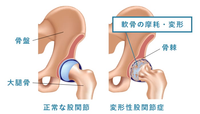 変形性股関節症