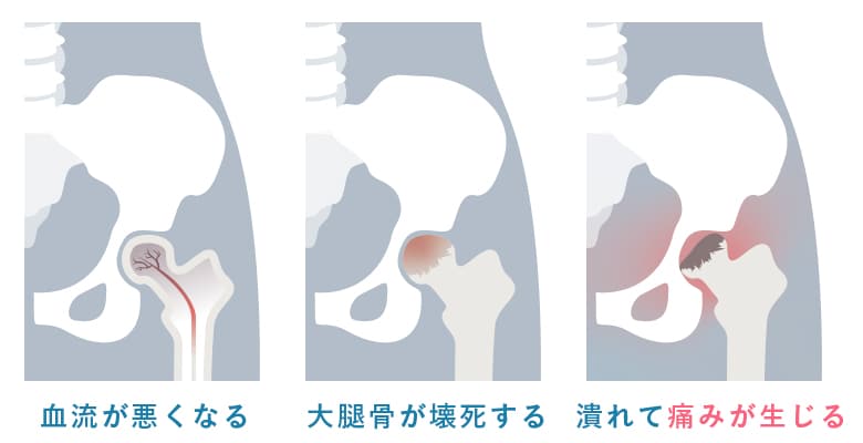 特発性大腿骨頭壊死症