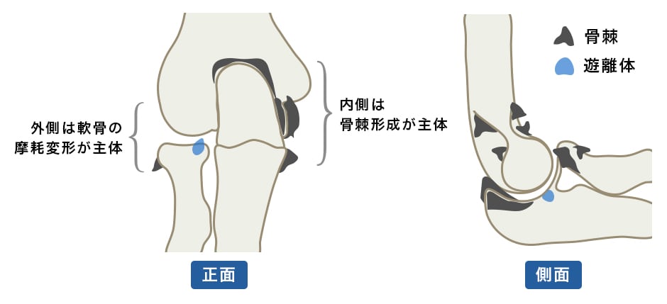 変形性肘関節症