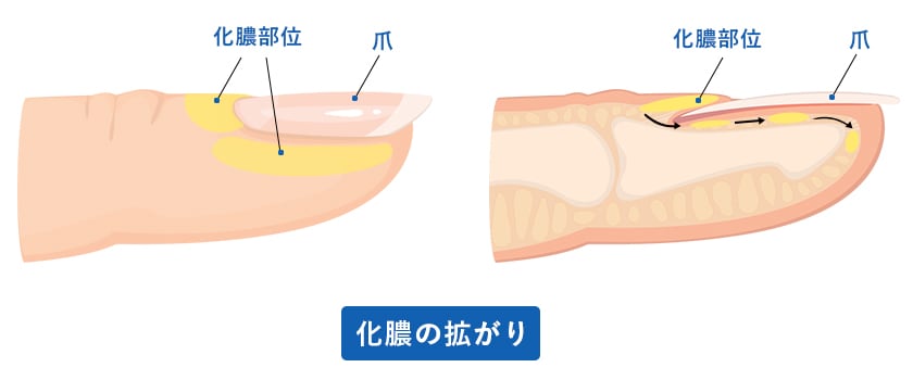 爪周囲炎