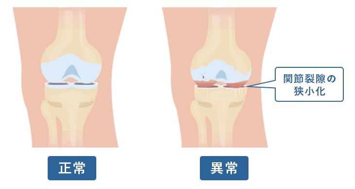 変形性膝関節症