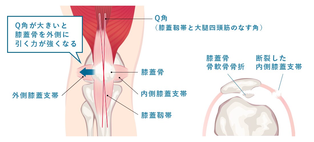 膝蓋骨脱臼