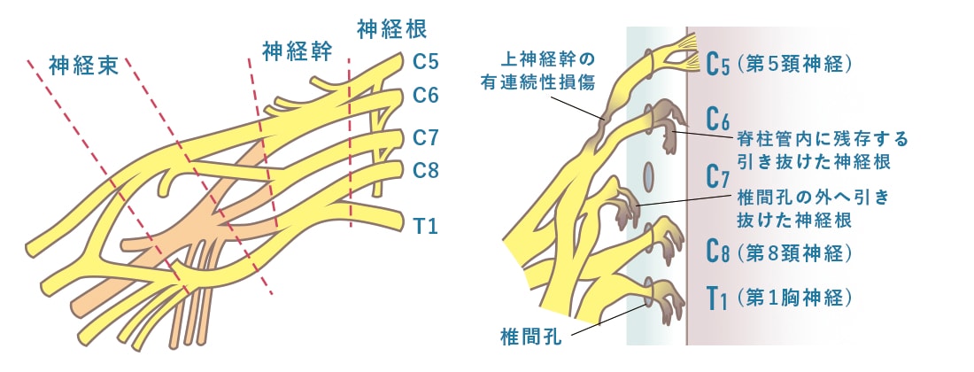 腕神経叢損傷