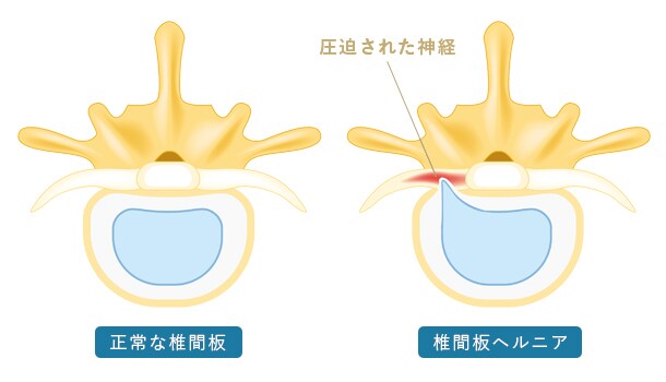 頚椎椎間板ヘルニア