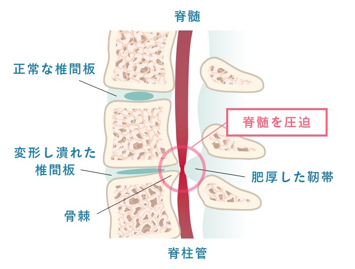 頚椎症性脊髄症