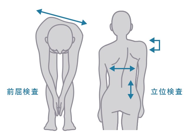 小児の脊柱側弯症