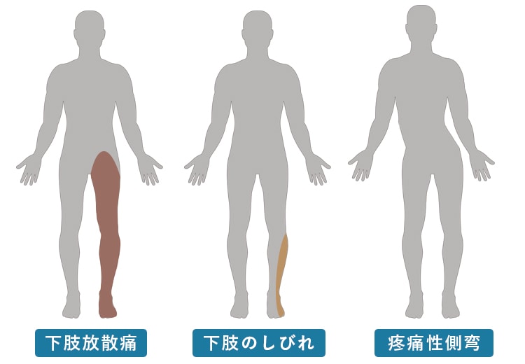 腰椎椎間板ヘルニア1