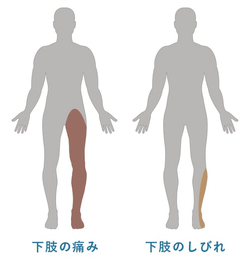 腰部脊柱管狭窄症