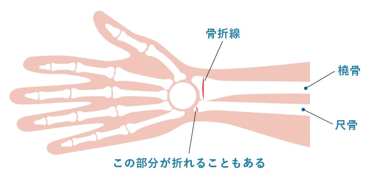 橈骨遠位端骨折の骨折部位