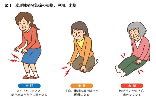 図1 変形性膝関節症の初期、中期、末期
