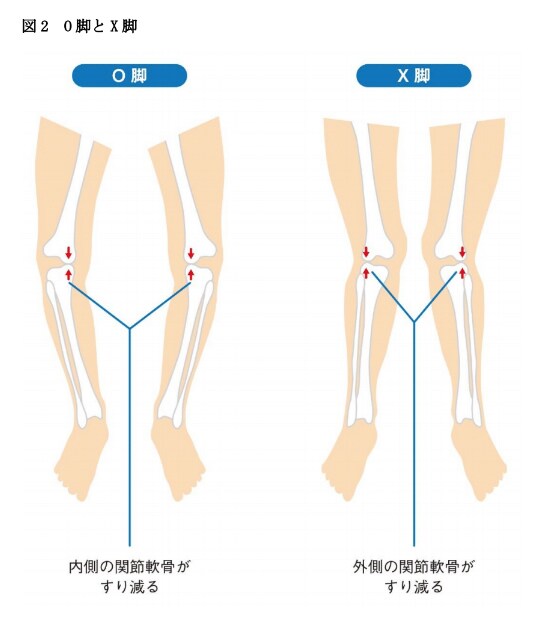 図2 O脚とX脚
