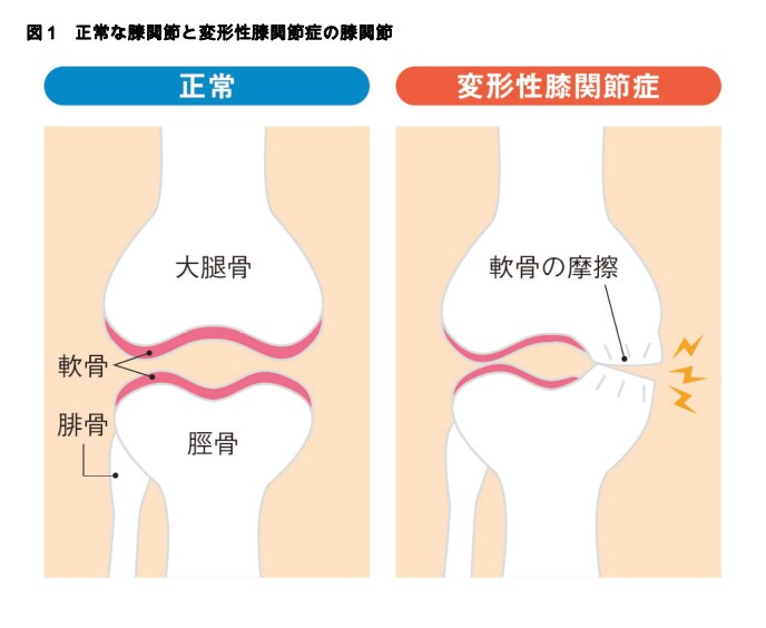図1 正常な膝関節と変形性膝関節症の膝関節