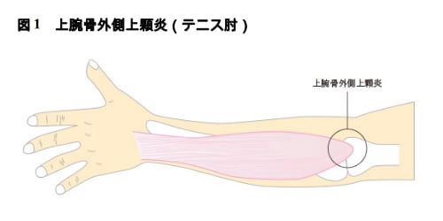 図1 上腕骨外側上顆炎