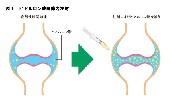 図1 ヒアルロン酸関節内注射