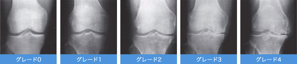 グレード0~4