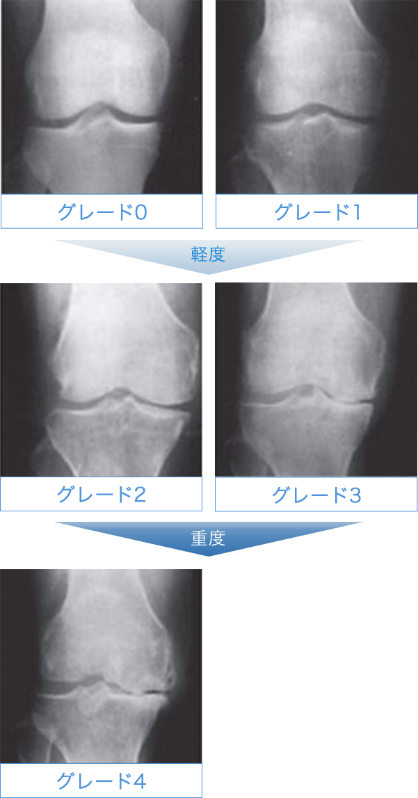グレード0~4