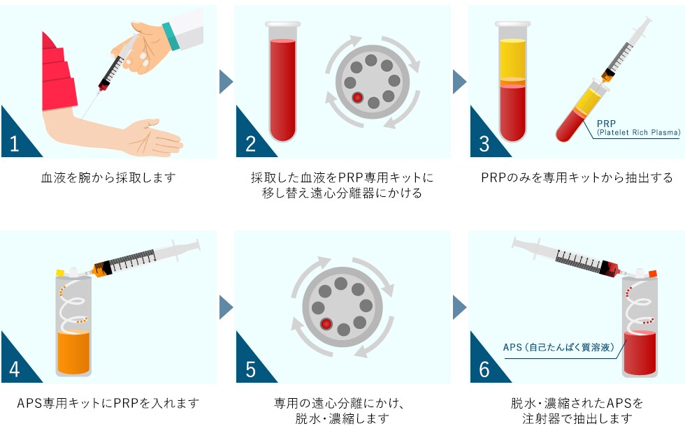 APS生成工程