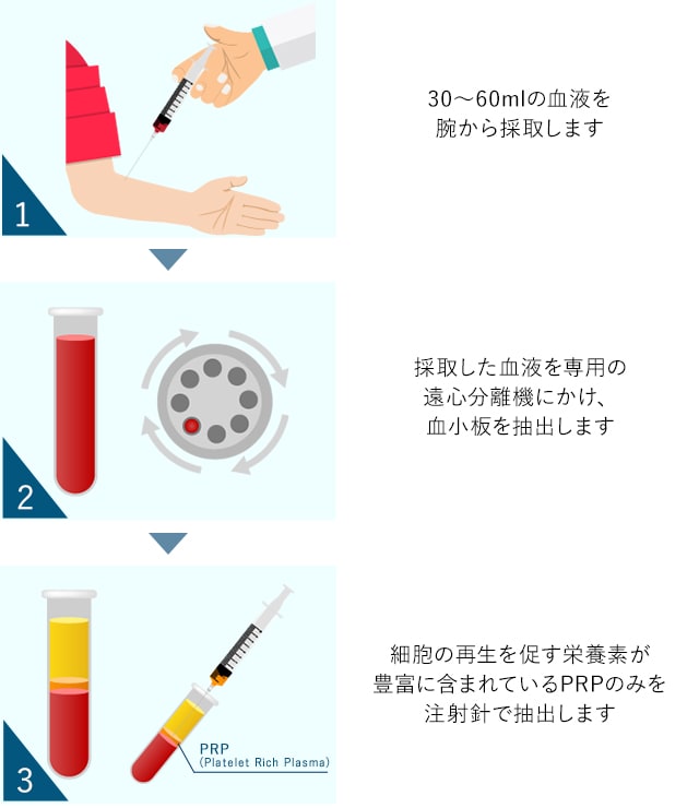 PRP療法の仕組み