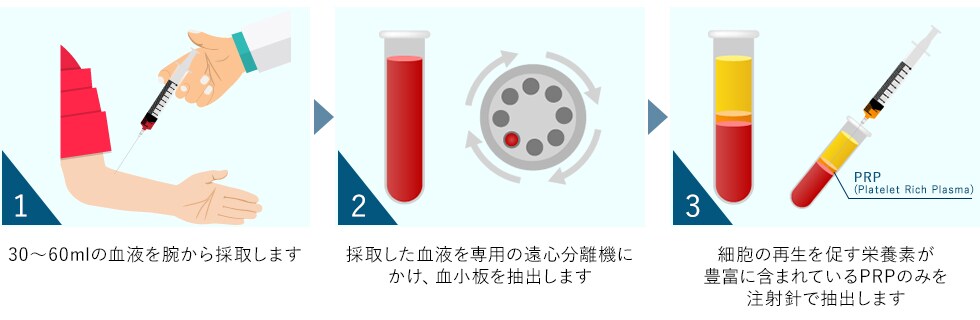 PRP療法の仕組み