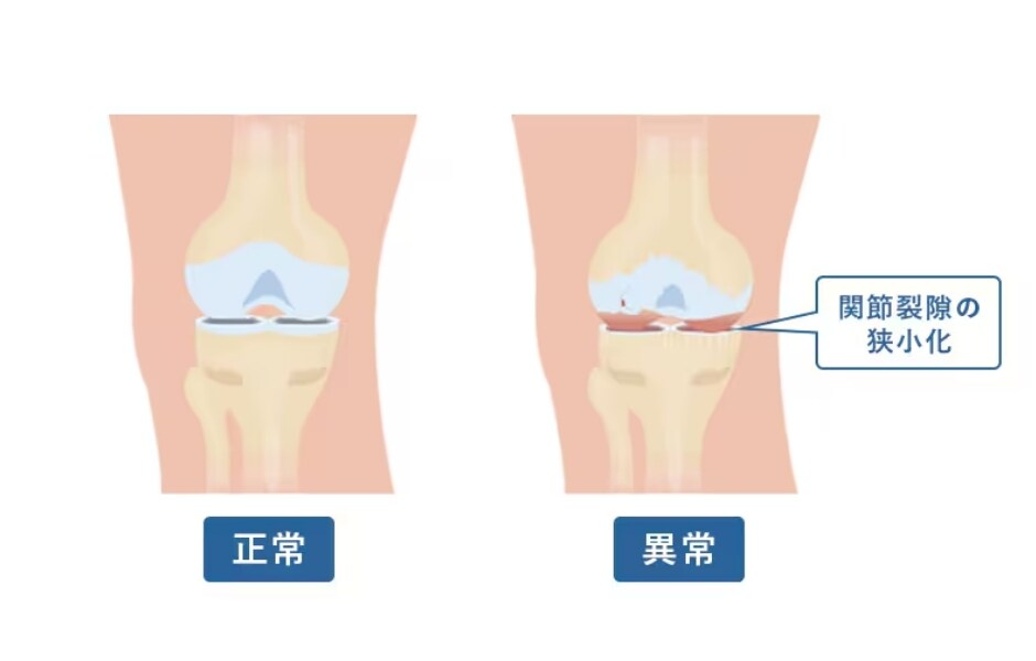 変形性膝関節症