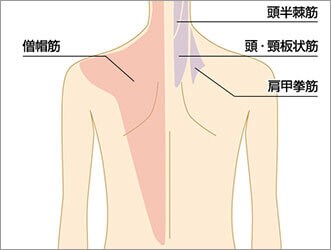 肩こりボトックスとは？
