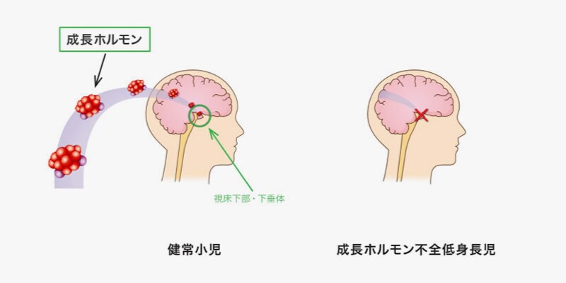 成長ホルモン分泌不全