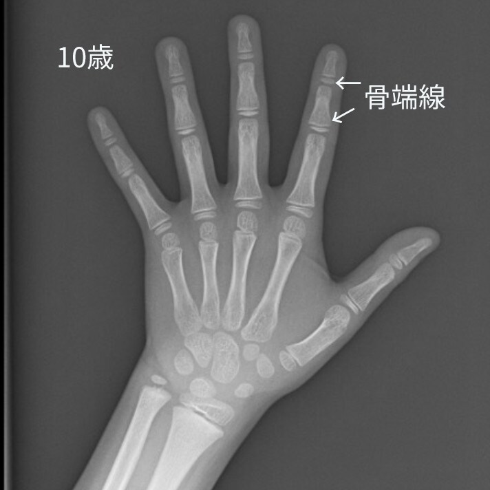 骨端線が見えるレントゲン