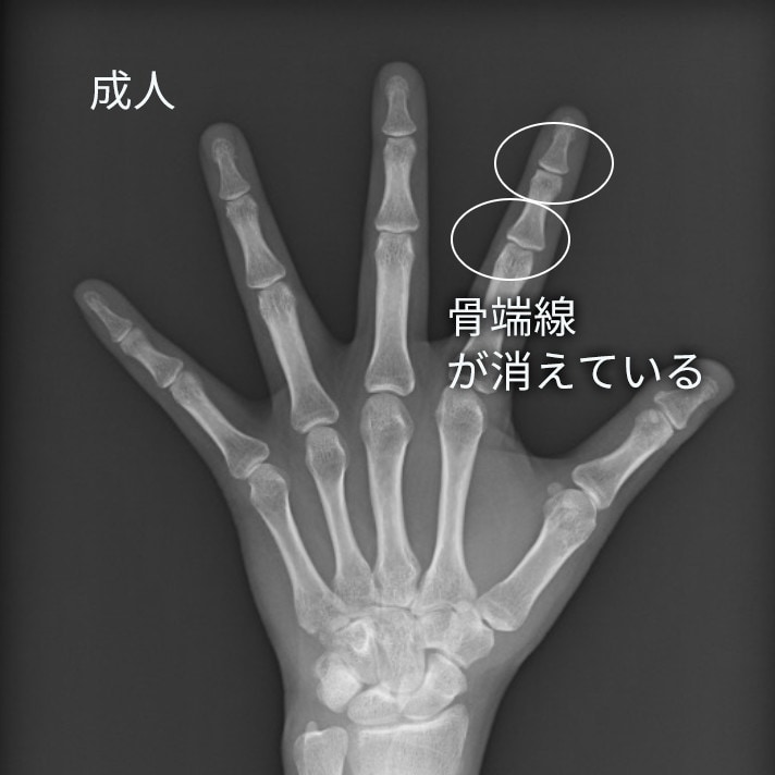 骨端線が消えたレントゲン